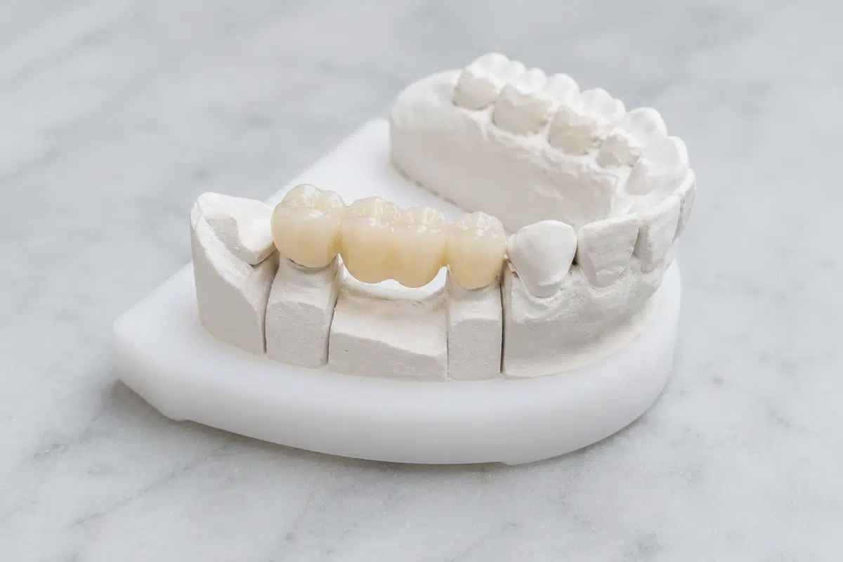 You are currently viewing Dental Bridge